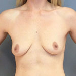 Breast Augmentation