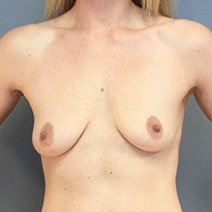 Breast Augmentation Case 3604 Before Photo Breast Augmentation