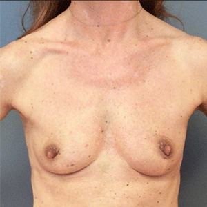 Breast Augmentation Case 2345 Before Photo Breast Augmentation