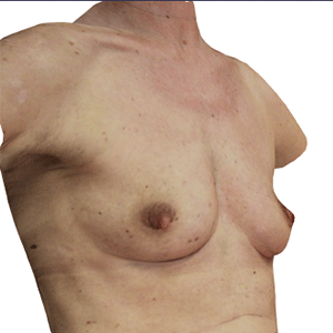 Breast Augmentation Case 2345 Before Photo Breast Augmentation