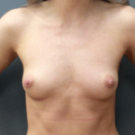 Breast Augmentation