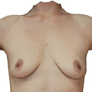 Breast Augmentation