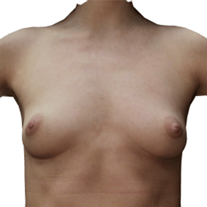 Breast Augmentation Case 3631 Before Photo Breast Augmentation