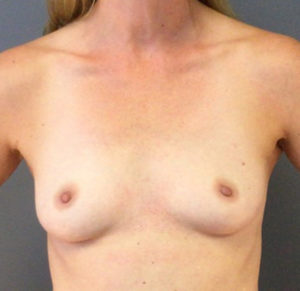 Breast Augmentation