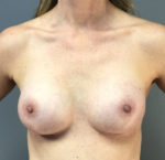 Breast Augmentation