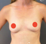 Breast Augmentation