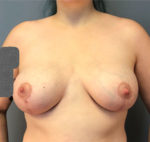 Breast Augmentation