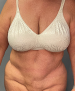 Abdominoplasty
