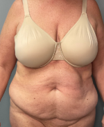 Abdominoplasty