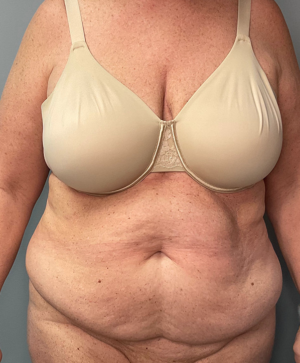 Abdominoplasty Case 3681 Before Photo Abdominoplasty