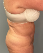 Abdominoplasty