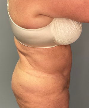 Abdominoplasty Case 3681 After Photo Abdominoplasty