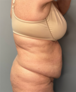 Abdominoplasty