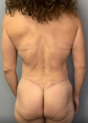 Body Lift