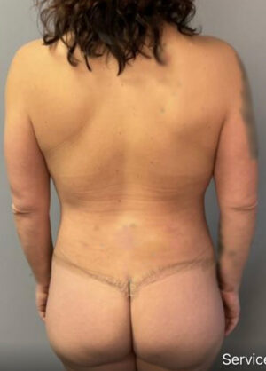 Body Lift