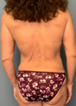 Body Lift