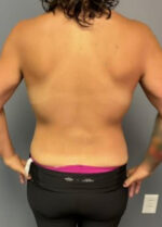 Body Lift