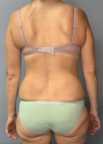 Body Lift
