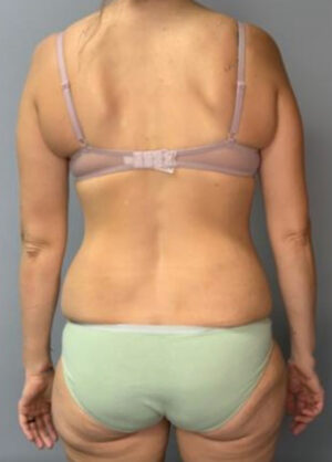 Body Lift