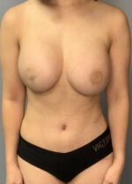 Abdominoplasty