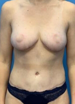 Abdominoplasty