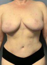 Abdominoplasty