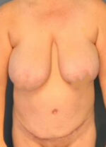 Abdominoplasty