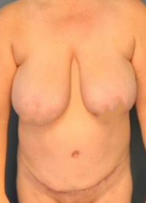 Abdominoplasty
