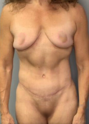 Body Lift