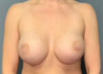 Breast Augmentation