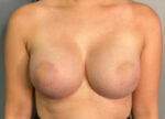 Breast Augmentation