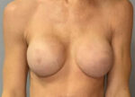 Breast Augmentation