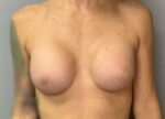 Breast Augmentation