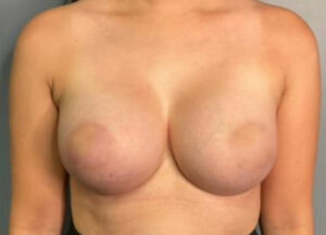 Breast Augmentation