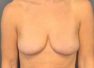 Breast Lift