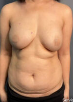 Abdominoplasty