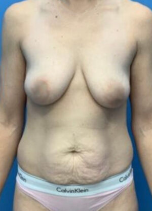 Abdominoplasty