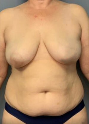 Abdominoplasty