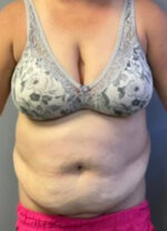 Abdominoplasty