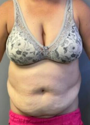 Abdominoplasty