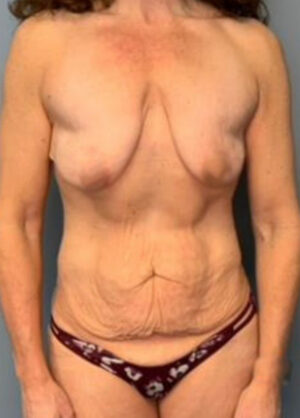 Body Lift