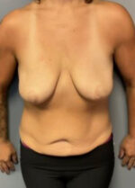 Body Lift