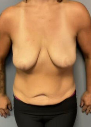 Body Lift