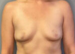 Breast Augmentation