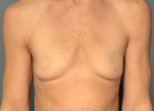 Breast Augmentation