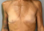Breast Augmentation