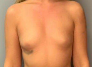 Breast Augmentation