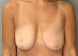 Breast Lift