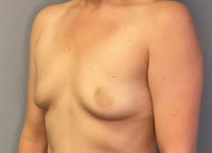 Breast Augmentation
