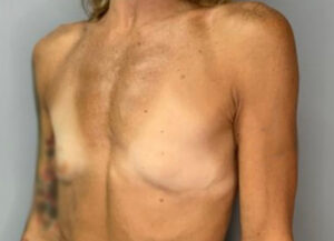 Breast Augmentation